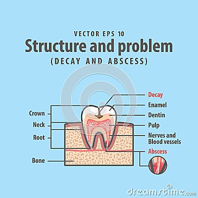 Decay and abscess cross-section structure inside tooth Vector Illustration