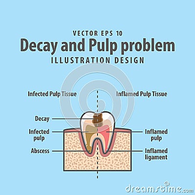 Decay and Pulp problem cross-section structure inside tooth Vector Illustration
