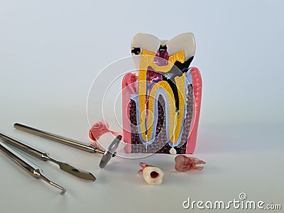 Decayed root tooth is removed. Caries and tooth extraction and dental treatment Stock Photo