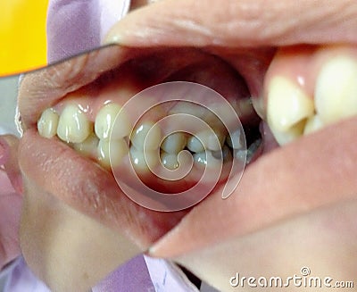 Decayed teeth check-up Stock Photo