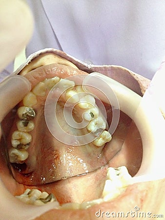 Decayed teeth check-up Stock Photo