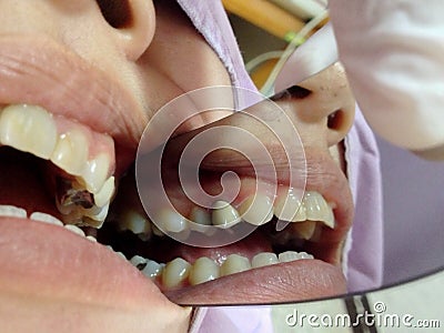 Decayed teeth check-up Stock Photo