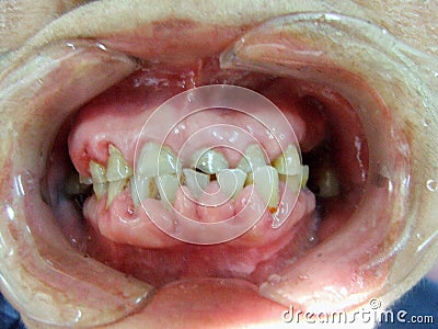 Decayed teeth check-up Stock Photo