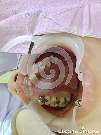 Decayed teeth check-up Stock Photo