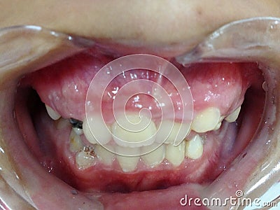 Decayed teeth check-up Stock Photo