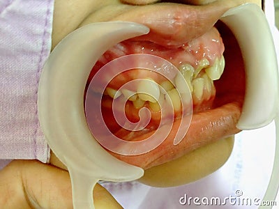 Decayed teeth check-up Stock Photo