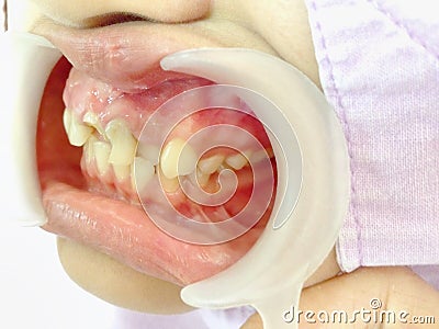Decayed teeth check-up Stock Photo