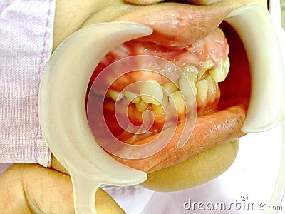 Decayed teeth check-up Stock Photo