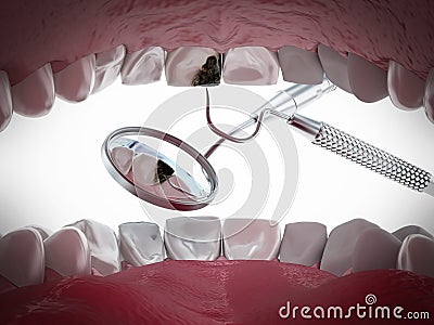 Decayed tooth diagnosis and treatment. 3D illustration Cartoon Illustration