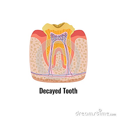 Decayed Tooth Poster Vector Illustration