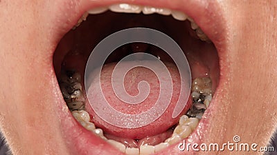 Decayed tooth root canal treatment. Tooth or teeth decay of lower molar Stock Photo