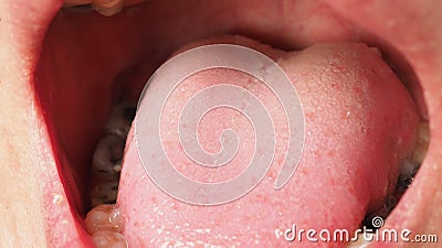 Decayed tooth root canal treatment. Tooth or teeth decay of lower molar Stock Photo