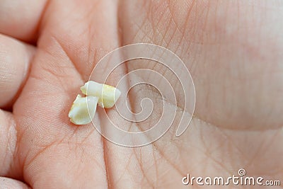 Deciduous primary baby temporary teeth, the first set of teeth in the growth and development of humans, They are usually lost and Stock Photo