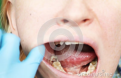 Deep caries, open canals, cleaning canals. Patient at stomatolon on admission, periodontitis treatment Stock Photo