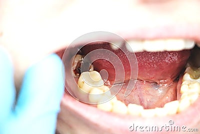 Deep caries, open canals, cleaning canals. Patient at stomatolon on admission, periodontitis treatment Stock Photo