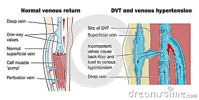 Deep vein thrombosis Vector Illustration