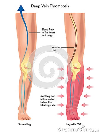 Deep vein thrombosis Vector Illustration