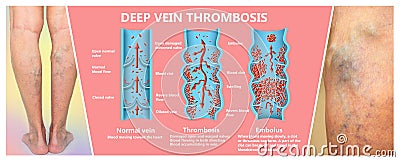 Deep Vein Thrombosis or Blood Clots. Embolus. Stock Photo