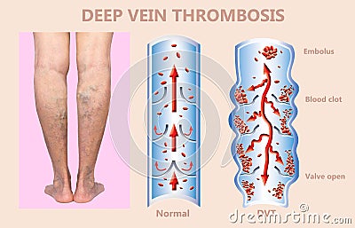Deep Vein Thrombosis or Blood Clots. Embolus. Stock Photo