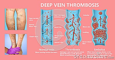 Deep Vein Thrombosis or Blood Clots. Embolus. Stock Photo