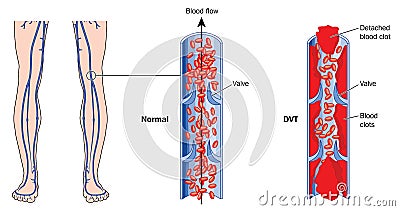 Deep vein thrombosis Vector Illustration