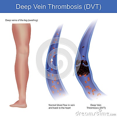 Deep vein thrombosis. In normal conditions red blood cell flow in vein and back to the heart, but the Deep Vein Thrombosis Stock Photo