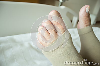 Deep Vein Thrombosis Stockings Stock Photo