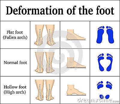 Deformation of the foot Vector Illustration