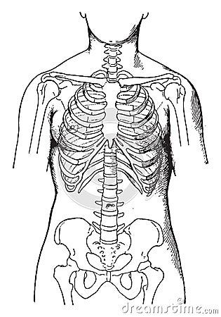 Deformed by the corsets, showing condition of bones in women who habitually wear tight corsets, vintage engraving Vector Illustration