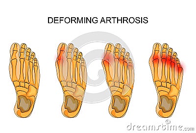 Deforming arthrosis of the foot Vector Illustration