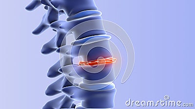 Human spine with degenerative disc Stock Photo