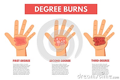 Degree burns of skin. Infographic Vector Illustration