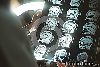 Brain MRI and dementia Stock Photo