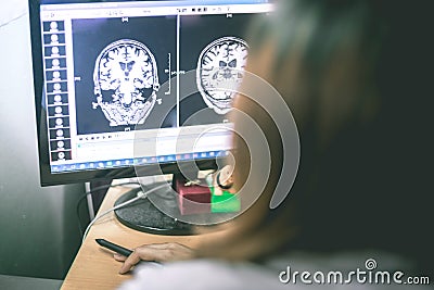 Dementia on MRI film. brain dementia. Stock Photo