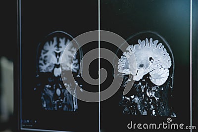 Dementia on MRI film. brain dementia. Stock Photo