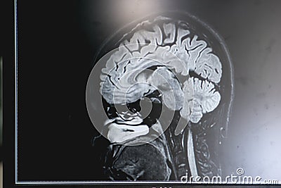 Dementia on MRI film. brain dementia. Stock Photo