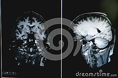 Dementia on MRI film. brain dementia. Stock Photo