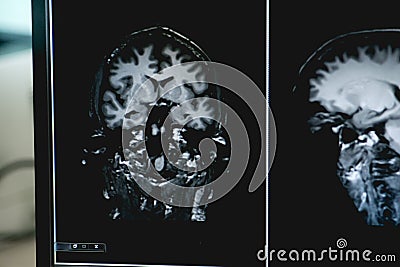 Dementia on MRI film. brain dementia. Stock Photo