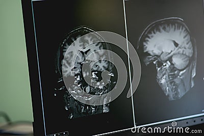 Dementia on MRI film. brain dementia. Stock Photo