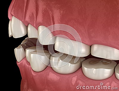 Dental attrition Bruxism resulting in loss of tooth tissue. Medically accurate tooth illustration Cartoon Illustration