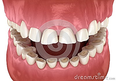 Dental attrition Bruxism resulting in loss of tooth tissue. Medically accurate tooth 3D illustration Cartoon Illustration
