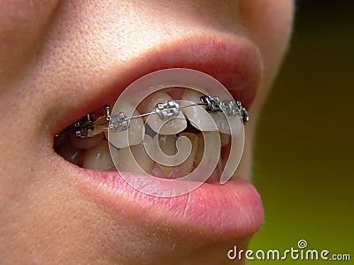 Dental braces Stock Photo