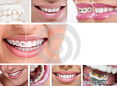 Dental braces Stock Photo
