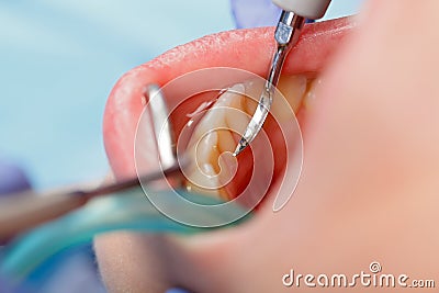 Dental calculus removing Stock Photo