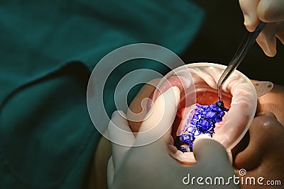 Dental care check up, Dentist examining and doing teeth treatment in dental clinic. Stock Photo