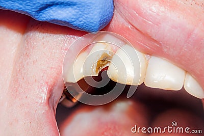 Dental caries. Filling with dental composite photopolymer material using rabbders. Concept of dental treatment in dental clinic Stock Photo