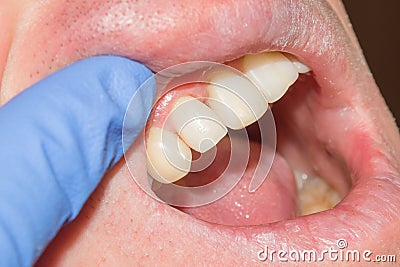 Dental caries. Filling with dental composite photopolymer material using rabbders. Concept of dental treatment in dental clinic Stock Photo