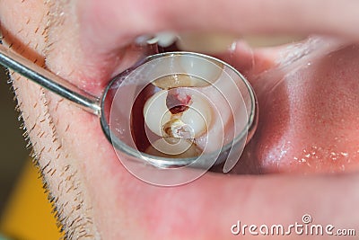 Dental caries. Filling with dental composite photopolymer material using rabbders. Concept of dental treatment in dental clinic Stock Photo