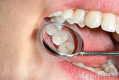 Dental caries. Filling with dental composite photopolymer material using rabbders. Concept of dental treatment in dental clinic Stock Photo