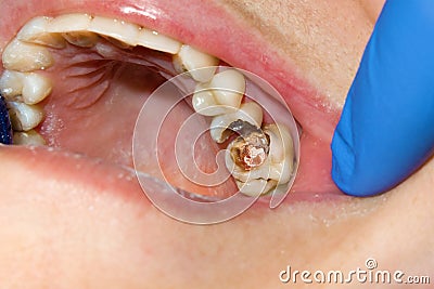 Dental caries. Filling with dental composite photopolymer material using rabbders. Concept of dental treatment in dental clinic Stock Photo